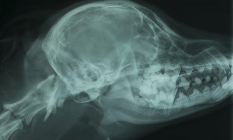 x ray Cervical Spondylomyelopathy